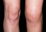 Professional Varicose Veins Treatment Cream