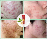 Ginseng Rapid Cure Acne Treatment