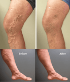 Professional Varicose Veins Treatment Cream