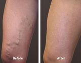 Professional Varicose Veins Treatment Cream