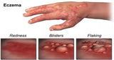 Anti Eczema & Psoriasis Essential Oil