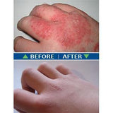 Anti Eczema & Psoriasis Essential Oil