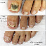 Anti-fungal Detox Foot Soak