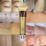 ACNE SCAR REMOVAL CREAM - SKIN REPAIR GEL