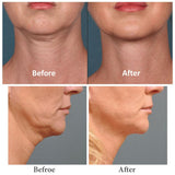 Neck Line Jawline Intense Serum