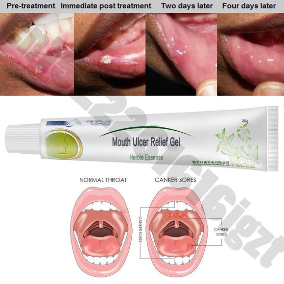 Mouth Ulcer Relief Gel